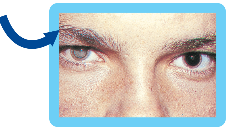 larva migrans ocular